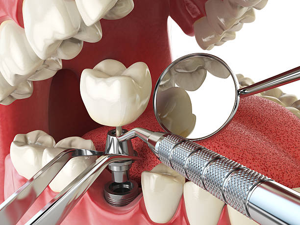 Best Urgent Care for Lost Fillings or Crowns in Salem, SD